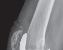 Illustration 4 for Porous Metal Cones: Biologic Fixation for Severe Bone Loss