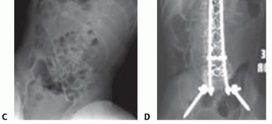 Illustration 31 for Duchenne Muscular Dystrophy: Is Spinal Fusion the Answer?