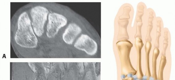 Fixation of Lisfranc Injuries: Essential Open Reduction Guide