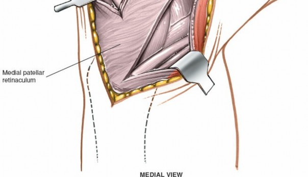 Illustration 77 for Mastering Knee Approaches: Spotlight on Superficial Medial Ligament