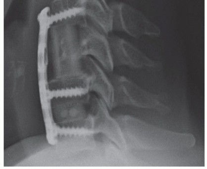 Illustration 29 for Stop Numbness & Instability: Corpectomy and Fusion Guide