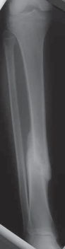 Illustration 8 for Optimal Nailing of the Tibia: Techniques for Challenging Fractures