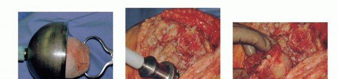 Illustration 12 for Bone Loss Bone Grafting for Challenging Tibial Defects