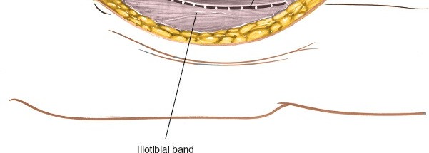 Illustration 6 for Optimal Femoral Approaches: Mastering the Lateral Intermuscular Septum