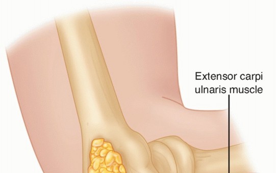 Illustration 16 for Radial Head & Neck Fractures: Mastering ORIF for Best Results