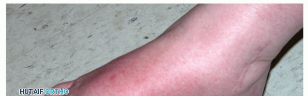 Illustration 3 for Regain Mobility: Surgical Solutions for Charcot Foot Arthropathy