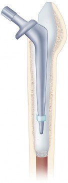 Illustration 23 for Cemented Femoral Stem Figures: Surgical Anatomy & Placement
