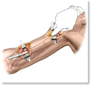 Illustration of approach to the distal - Dr. Mohammed Hutaif