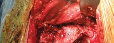 Illustration 20 for Optimizing Arthroplasty in Acute Fractures: Octopus System