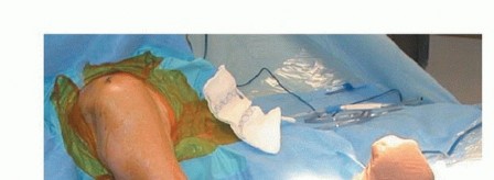 Illustration 7 for Stiff Shoulder? Discover Arthroscopic Capsular Release Solutions