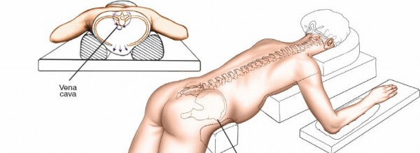Illustration 343 for Approach to the Lumbar Spine: Mastering Techniques & Anatomy