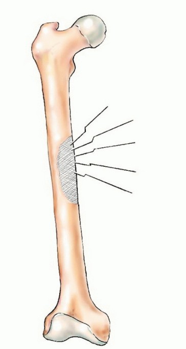 Illustration 8 for Plain Radiograph Showing MBD: Surgical Planning to Prevent Failures