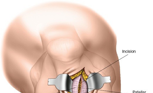 Illustration 79 for Optimal Femoral Approaches: Mastering the Lateral Intermuscular Septum