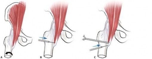Illustration 101 for Stop the Snap: Hip Preservation for Snapping Iliopsoas Tendon