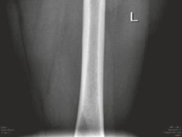 Illustration 5 for Surgical Hip Dislocation for Repair of the Labrum & CAM Lesion