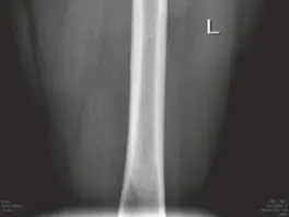 خلع مفصل الورك الجراحي لعلاج الاحتكاك الفخذي الحقي: دليل شامل للمرضى