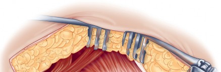 Illustration 35 for Direct Lateral Hip: Optimize Exposure with Sharp Curved Hohmann