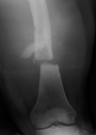 Don't Miss It: Critical Evaluation of Femoral Shaft and Neck Fractures