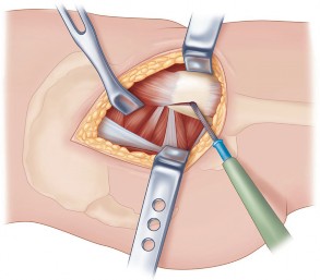 Illustration 23 for Figure Hip Resurfacing: Who Benefits and Who Should Avoid It?