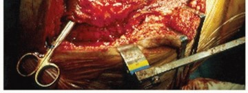 Illustration 32 for Sliding Trochanteric Osteotomy: Modern Role & Refined Techniques