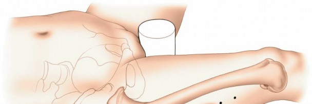 Illustration 64 for Optimal Femoral Approaches: Mastering the Lateral Intermuscular Septum