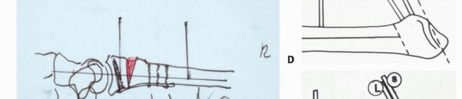Illustration 8 for Precision Correction for Distal Radius Malunion