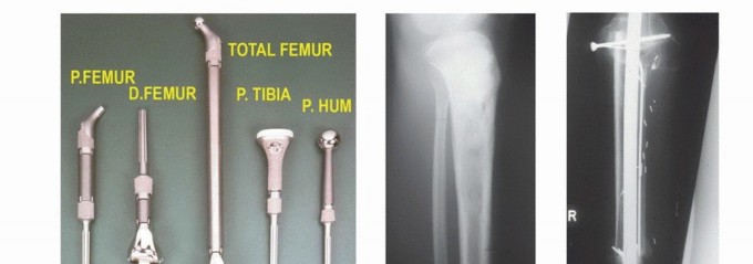 Illustration 29 for Understanding Benign Bone Tumors: Your Complete Preoperative Guide