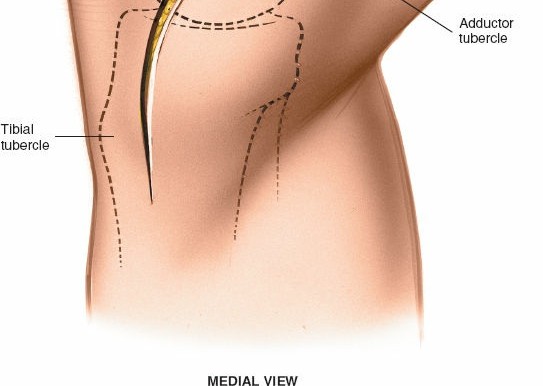 Illustration 66 for Mastering Knee Approaches: Spotlight on Superficial Medial Ligament