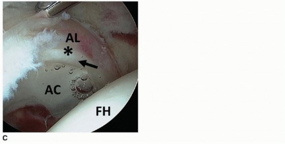 Illustration 20 for Beyond Knee Surg: Hip Arthroscopy for Sports Injuries