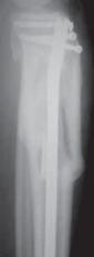 Illustration 62 for Optimal Nailing of the Tibia: Techniques for Challenging Fractures