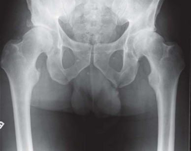 Illustration 82 for Metal on Metal Resurfacing: Enhanced Posterior Soft Tissue Repair