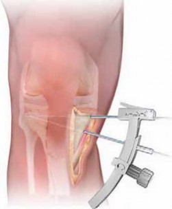 Illustration 28 for Guide Pin Assembly: Key to Flawless Upper Tibial Osteotomy