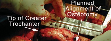 Illustration 14 for Achieving Success with Trochanteric Osteotomy Posterior for Revision