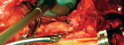 Illustration 65 for Cemented Component Longevity: The Critical Margin of the Acetabulum