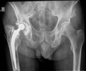 THA Wear Explained: Decoding the Critical Modes of Wear