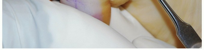 Illustration 16 for MTP Joint Arthrodesis: The Key to Optimal Toe Positioning