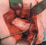 Illustration 18 for Increased Femoral Anteversion: A Proximal Femoral Rotational Osteotomy