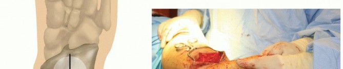 Illustration 30 for Unlock Stability: Medullary Nail Fixation for Tibiotalocalcaneal Arthrodesis