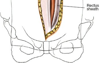 Illustration 85 for Approach to the Lumbar Spine: Mastering Techniques & Anatomy