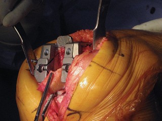 Illustration 43 for Posterior Stabilized Technique: Essential Insights for TKA Success