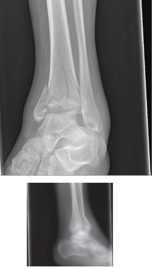 Illustration of case pilon fracture - Dr. Mohammed Hutaif