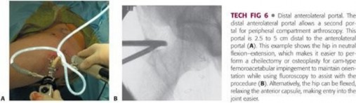 Illustration 229 for Understanding Hip Arthroscopy: The Basics Explained