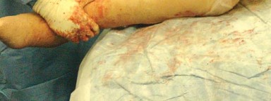 صورة طبية: إتقان توازن الأنسجة الرخوة لمفصل ورك صناعي مثالي: دليل شامل للمرضى مع الأستاذ الدكتور محمد هطيف