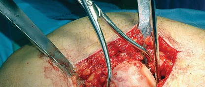 Illustration 33 for Unlock the Figure Posterior Approach to the Hip