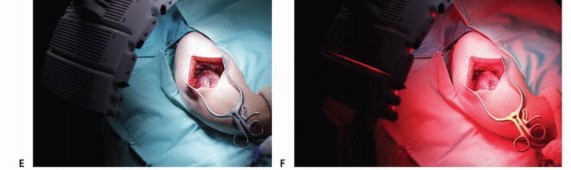 Illustration 14 for Targeted Ablation of Musculoskeletal Tumors: A Safer Approach
