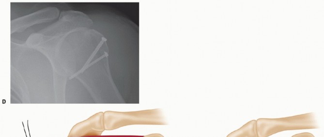 Illustration 10 for Optimizing Fixation of Proximal Humerus Fractures: A Guide
