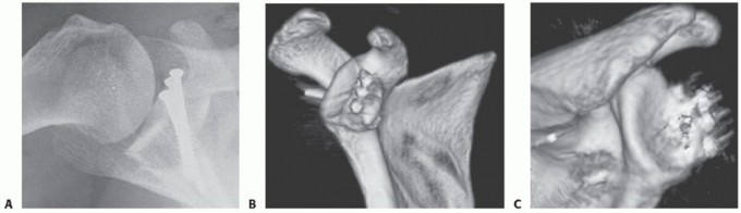 Illustration 29 for Glenoid Bone Graft for Anterior Shoulder Instability: Restore Stability