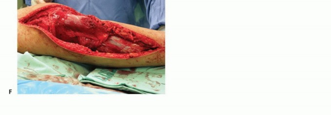 Illustration 43 for Tackling Complex Tumors of the Proximal Tibia: Limb-Sparing Solutions