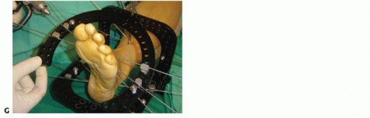 Illustration 62 for Mastering Midfoot Arthrodesis: Protect the Deep Neurovascular Bundle