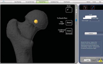 Illustration 25 for Robotics in Total Hip Arthroplasty: A New Era of Precision